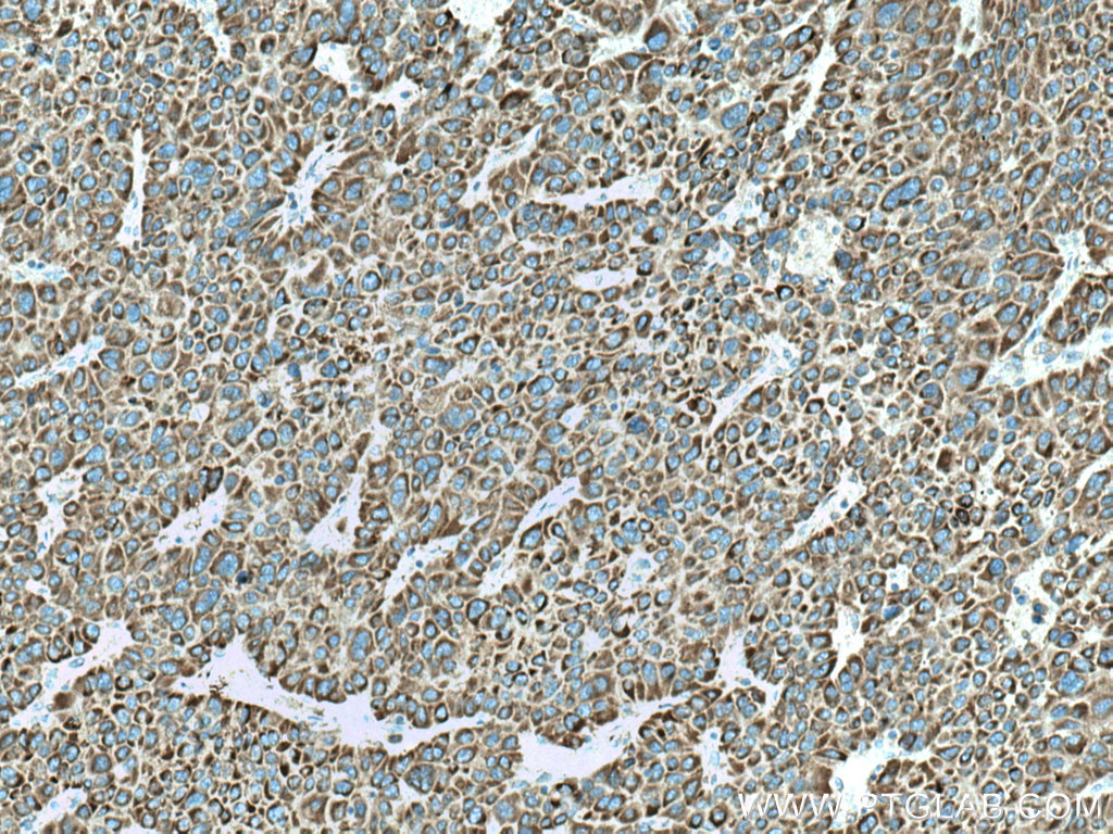 IHC staining of human liver cancer using 67045-1-Ig