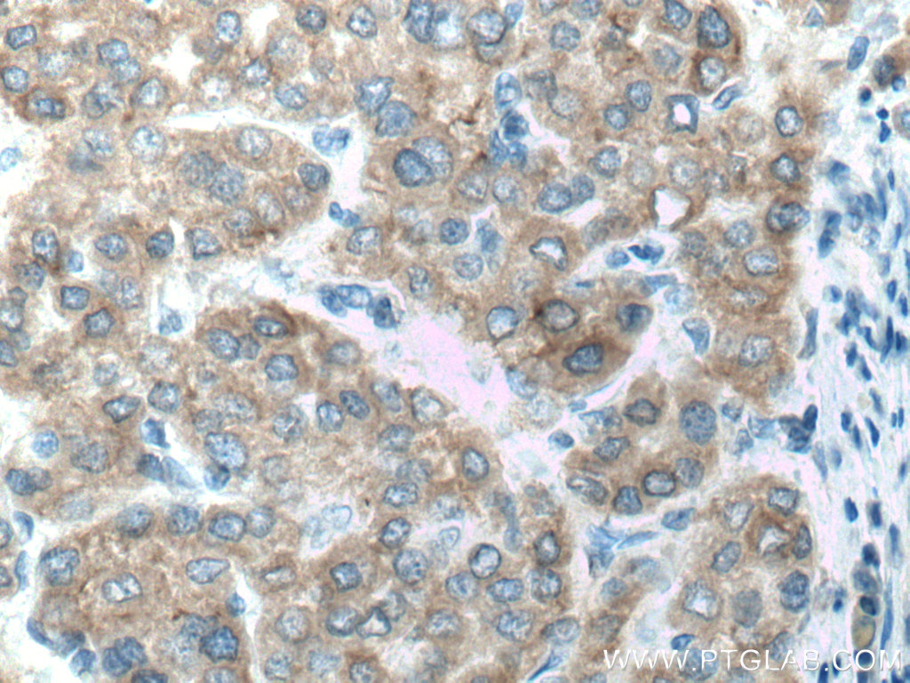 IHC staining of human liver cancer using 17868-1-AP