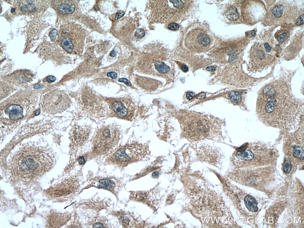 IHC staining of human liver cancer using 60297-1-Ig