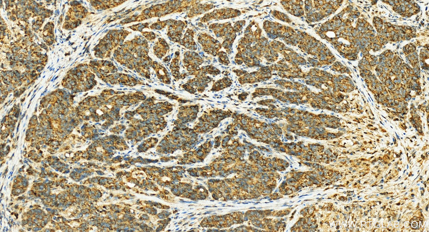 IHC staining of human stomach cancer using 12904-1-AP
