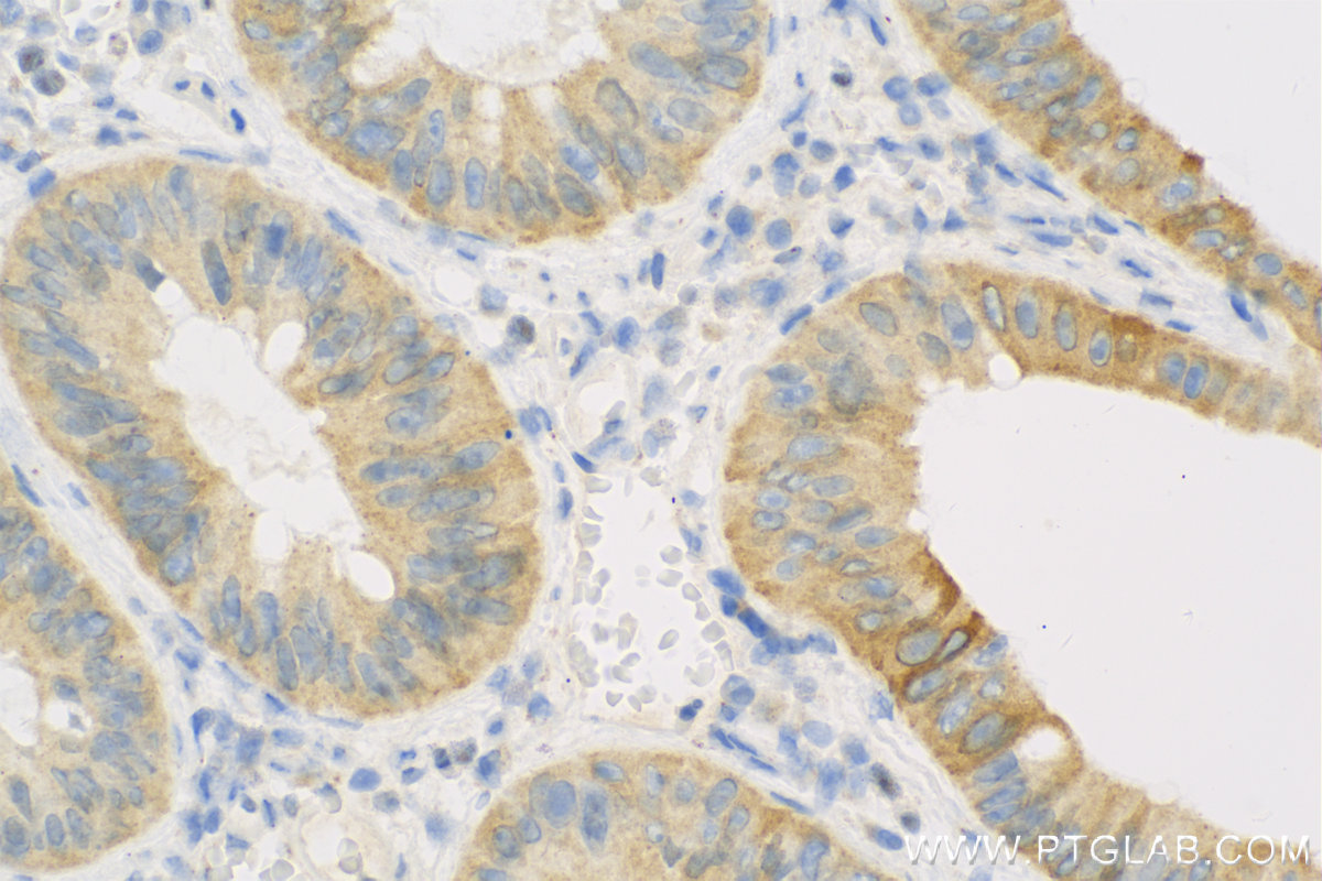 IHC staining of Human Colon cancer using 12904-1-AP