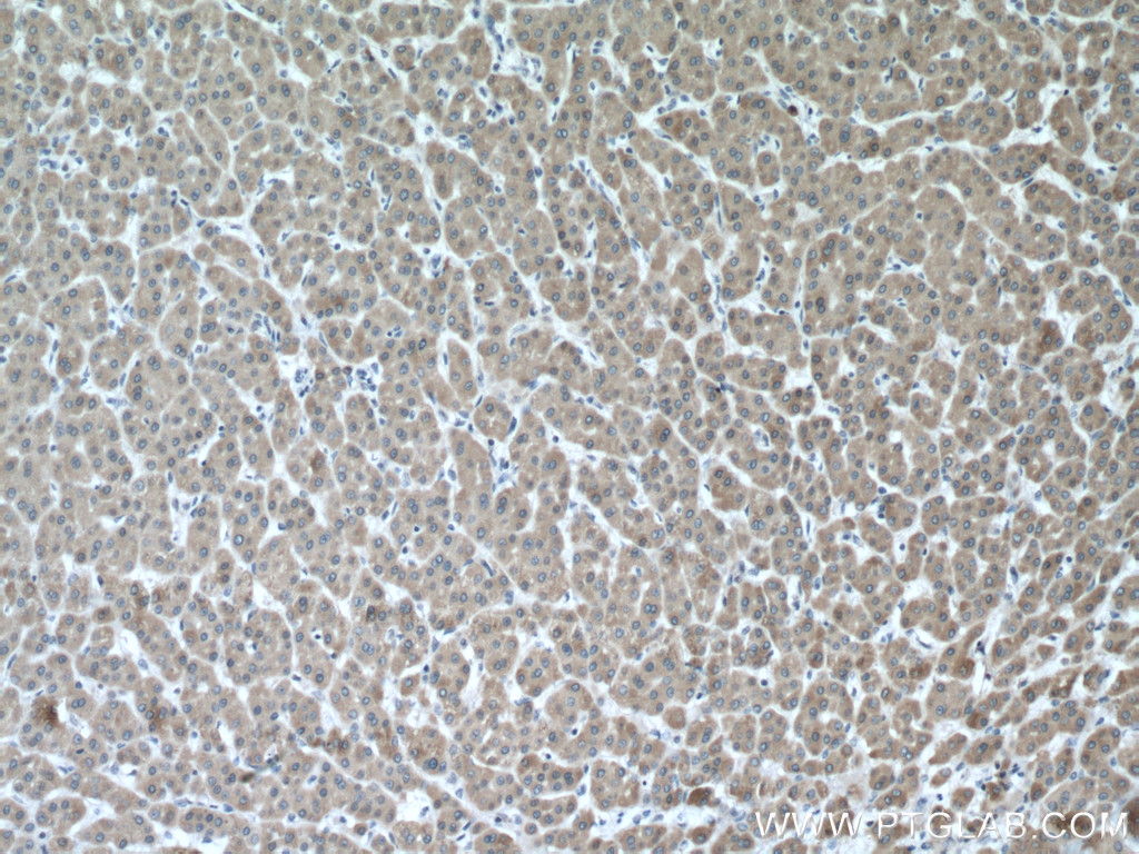 IHC staining of human liver cancer using 13737-1-AP