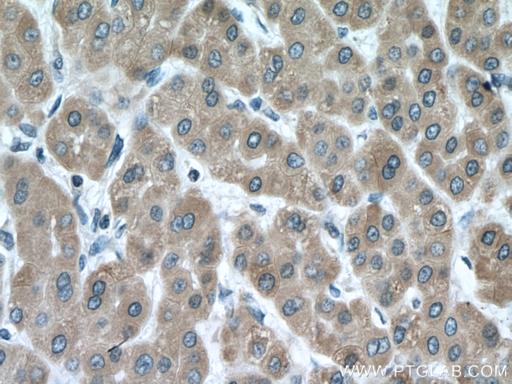IHC staining of human liver cancer using 13737-1-AP