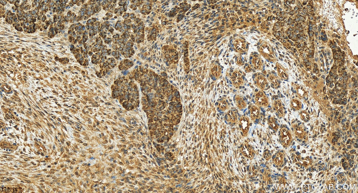 IHC staining of human ovarian  cancer using 19701-1-AP