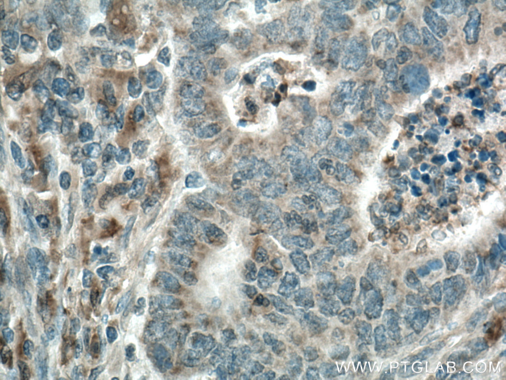 IHC staining of human colon cancer using 26689-1-AP