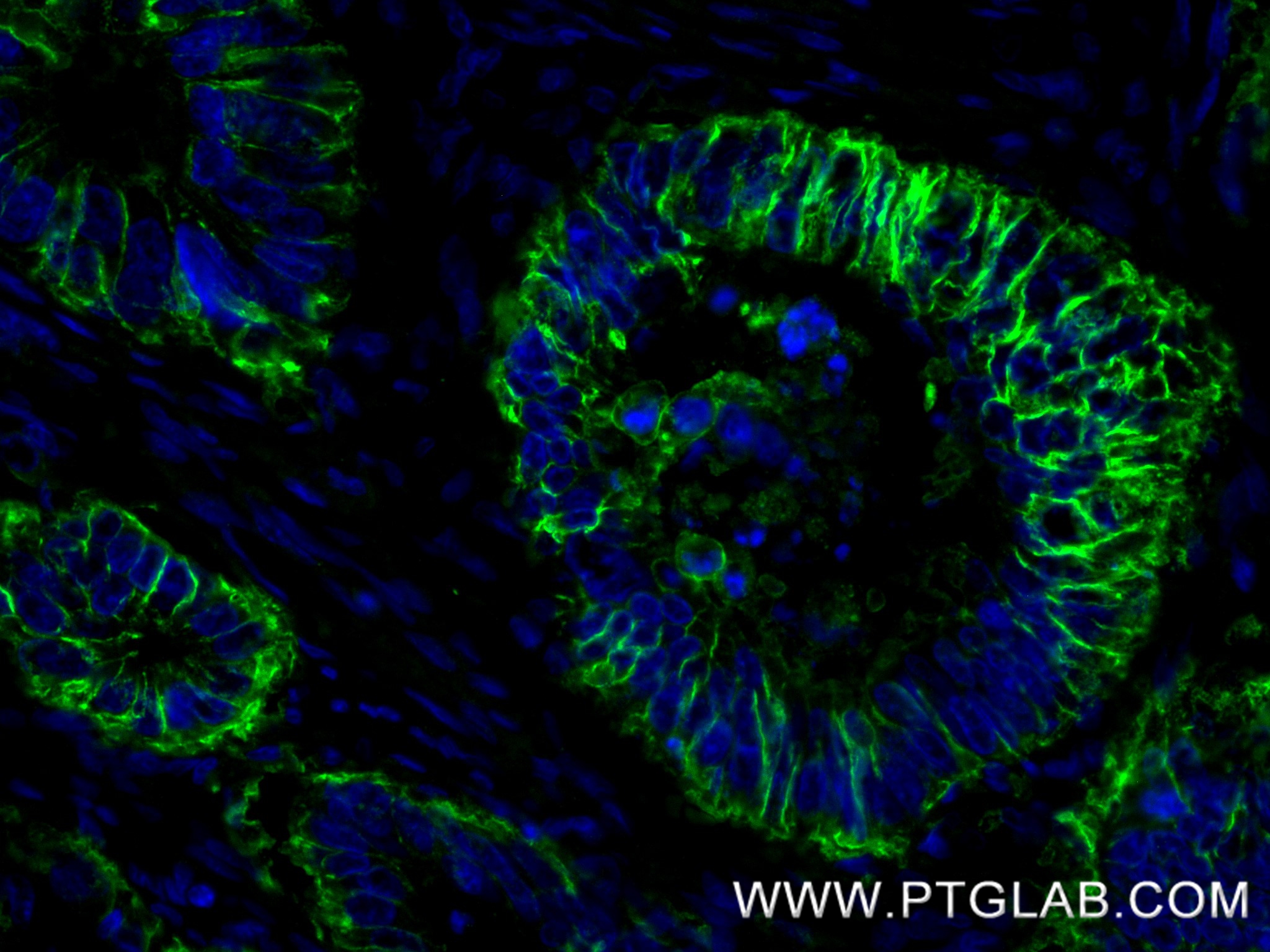 IF Staining of human colon cancer using 83793-5-RR