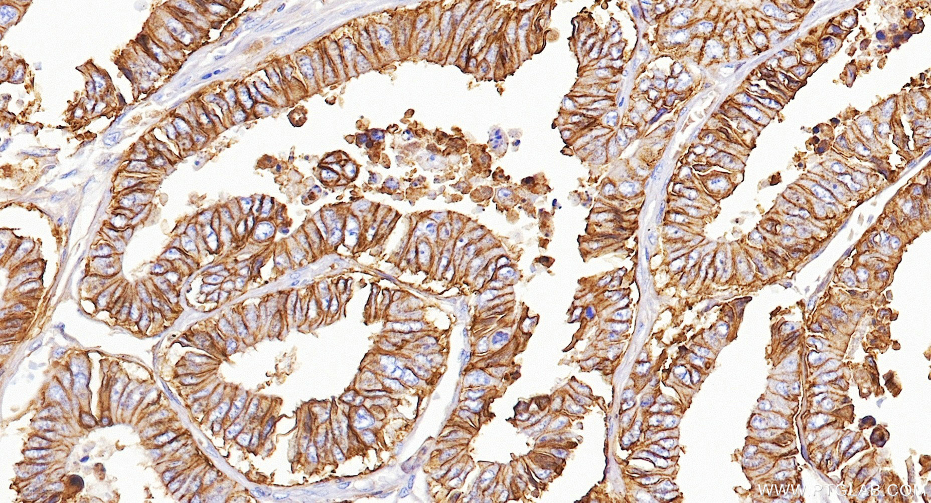 IHC staining of human colon cancer using 83793-5-RR