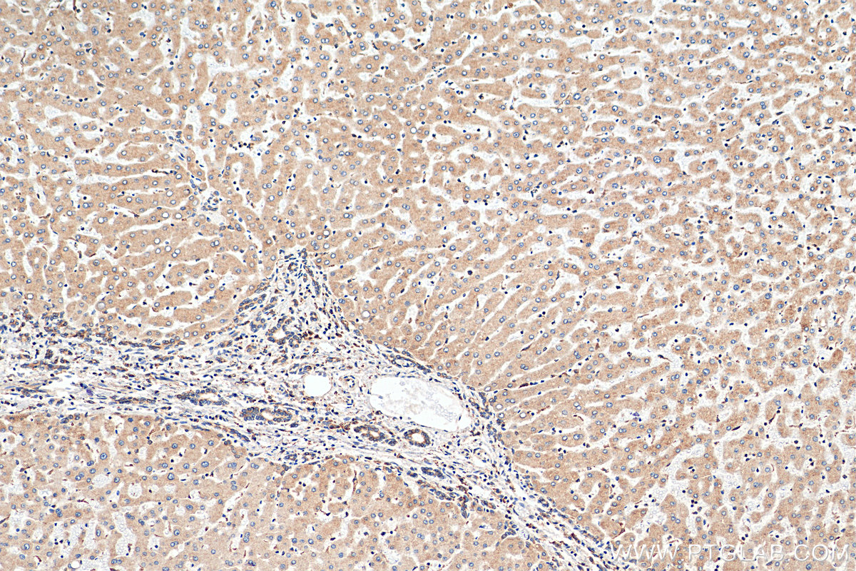 IHC staining of human hepatocirrhosis using 66903-1-Ig