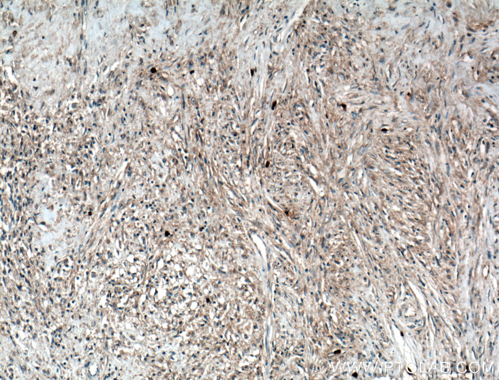 IHC staining of human myofibroblastoma using 66540-1-Ig (same clone as 66540-1-PBS)