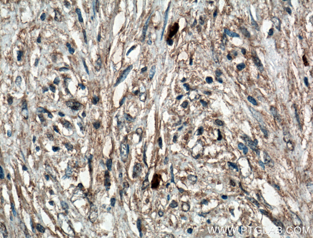 IHC staining of human myofibroblastoma using 66540-1-Ig (same clone as 66540-1-PBS)