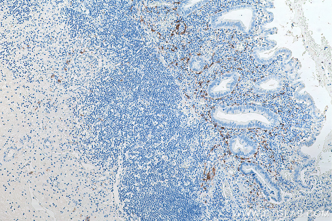 IHC staining of human appendicitis using 66496-1-Ig (same clone as 66496-1-PBS)