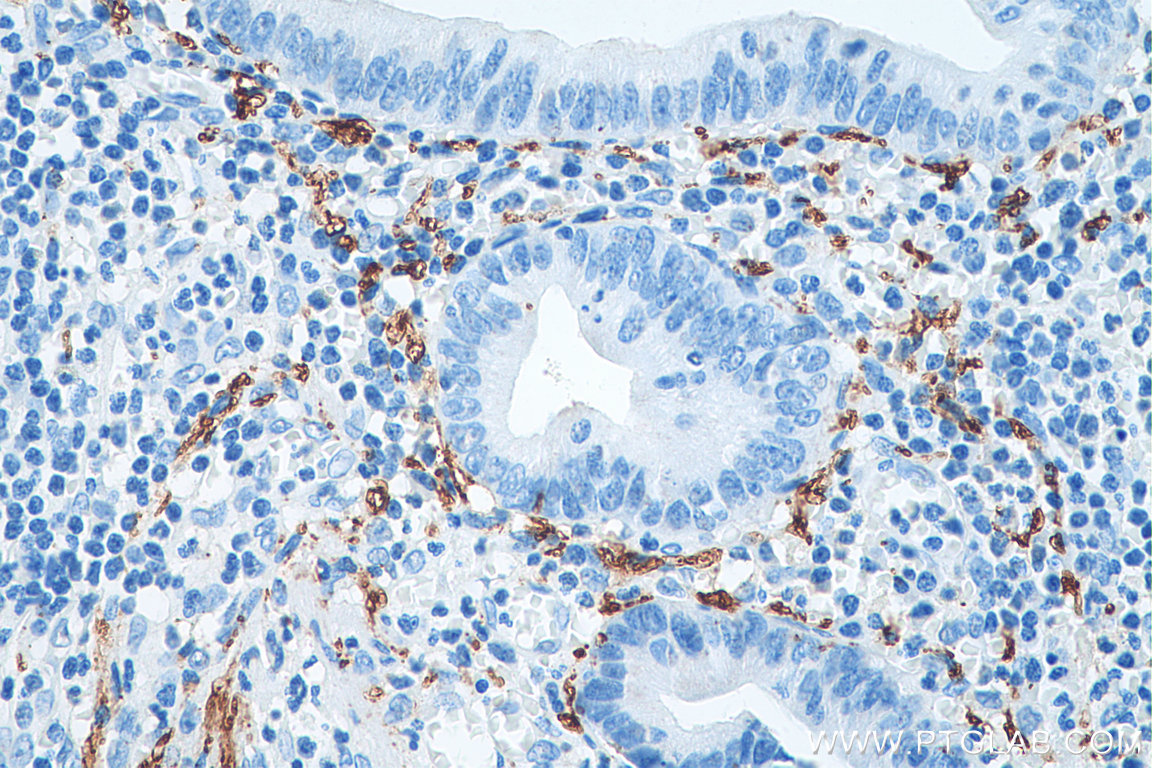 IHC staining of human appendicitis using 66496-1-Ig (same clone as 66496-1-PBS)