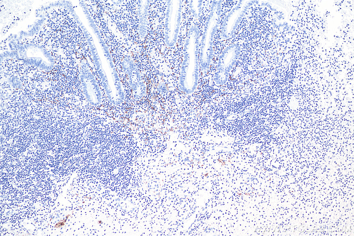 IHC staining of human appendicitis using 66496-1-Ig (same clone as 66496-1-PBS)