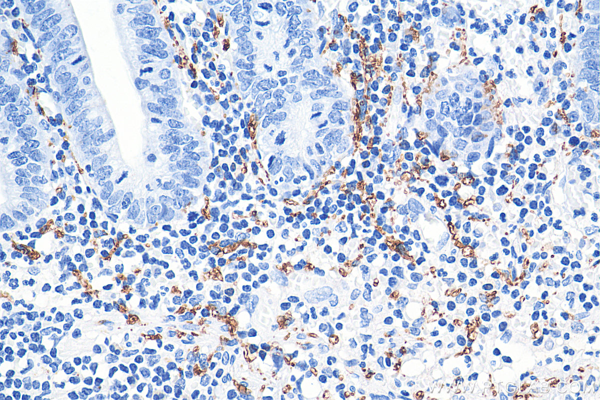 IHC staining of human appendicitis using 66496-1-Ig (same clone as 66496-1-PBS)