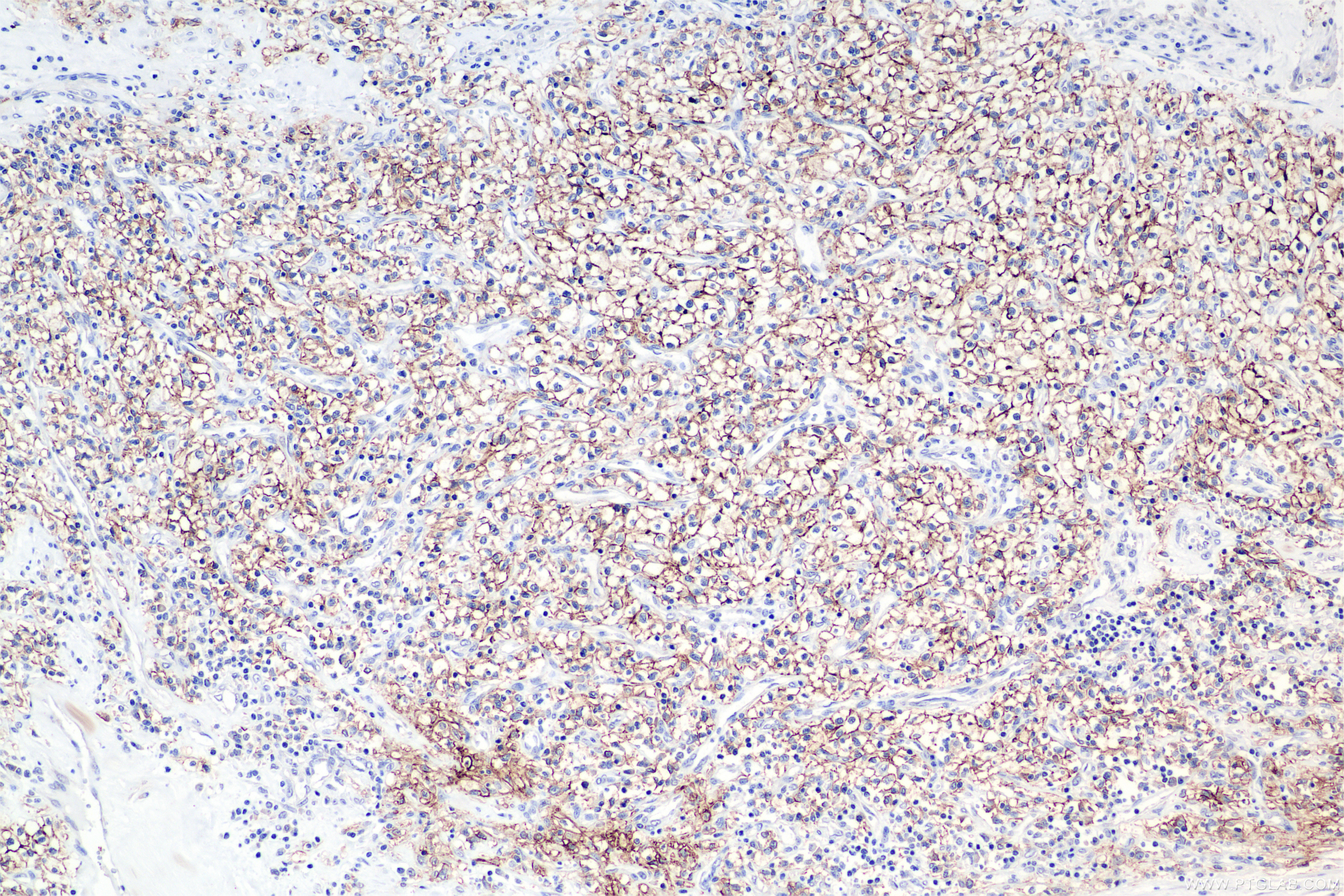 IHC staining of human kidney(renal cell) cancer using 84233-8-RR IHC staining of human kidney(renal cell) cancer using 84233-8-RR