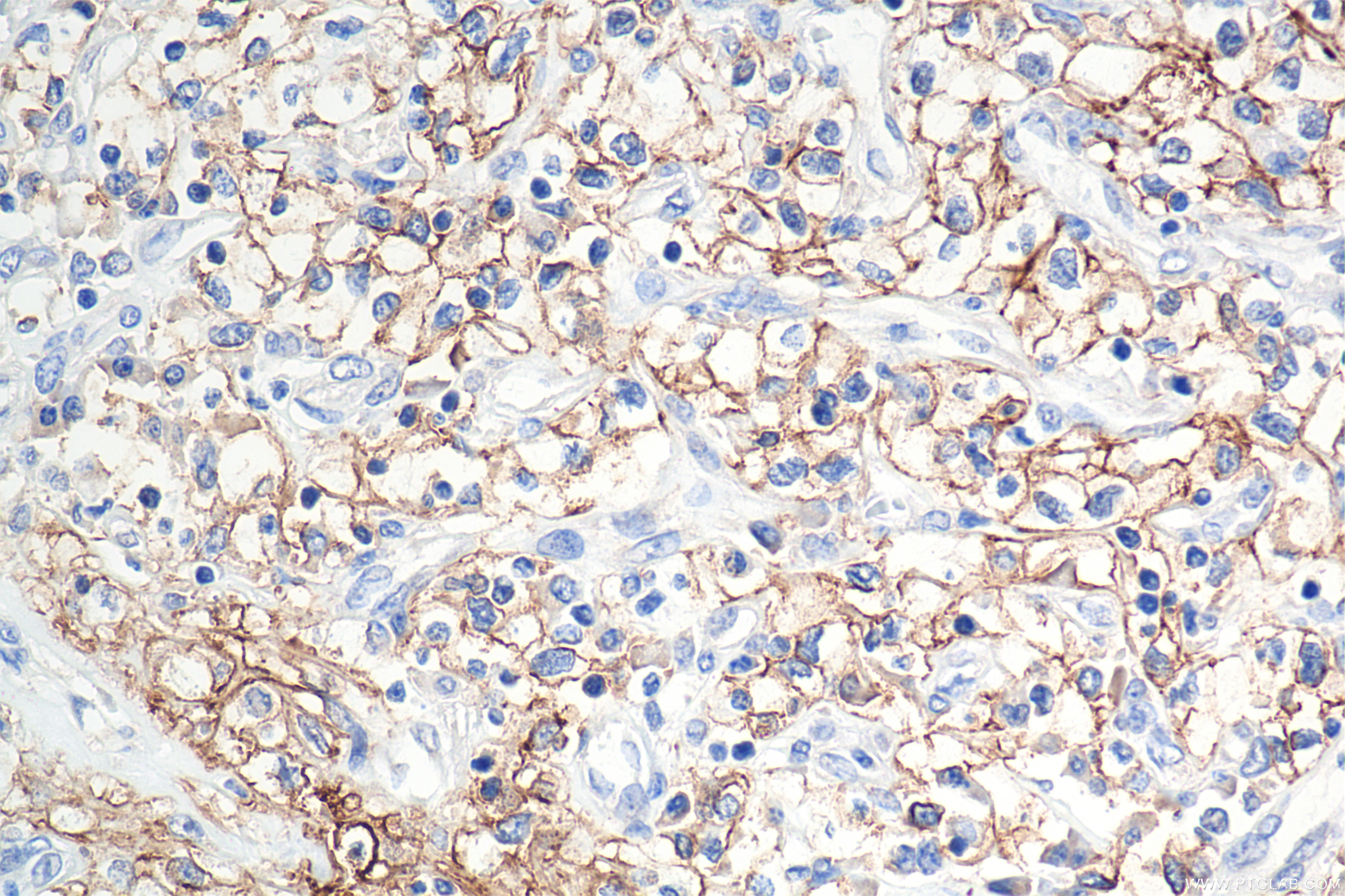 IHC staining of human kidney(renal cell) cancer using 84233-8-RR IHC staining of human kidney(renal cell) cancer using 84233-8-RR