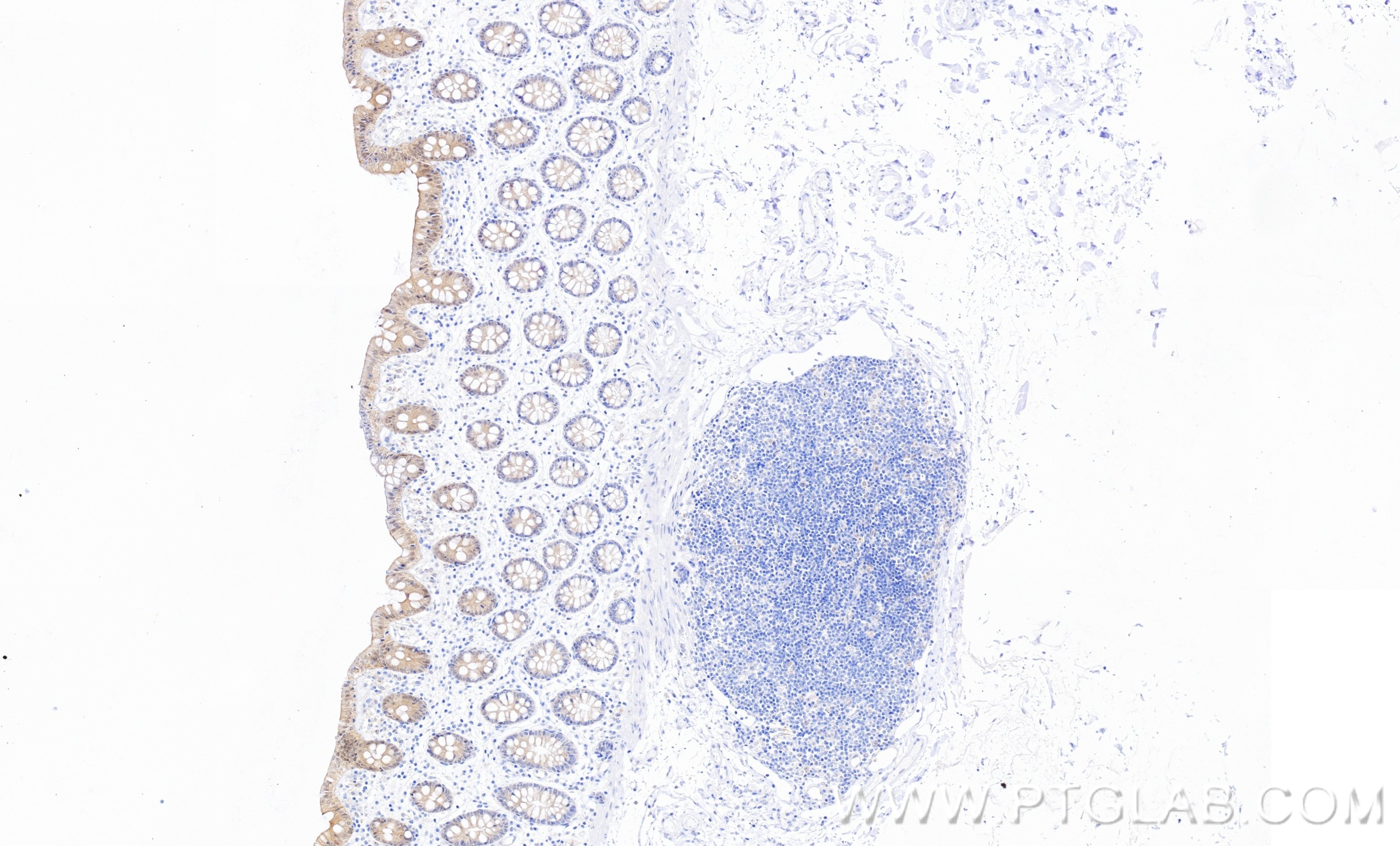 IHC staining of human colon using 86423-2-RR (same clone as 86423-2-PBS)