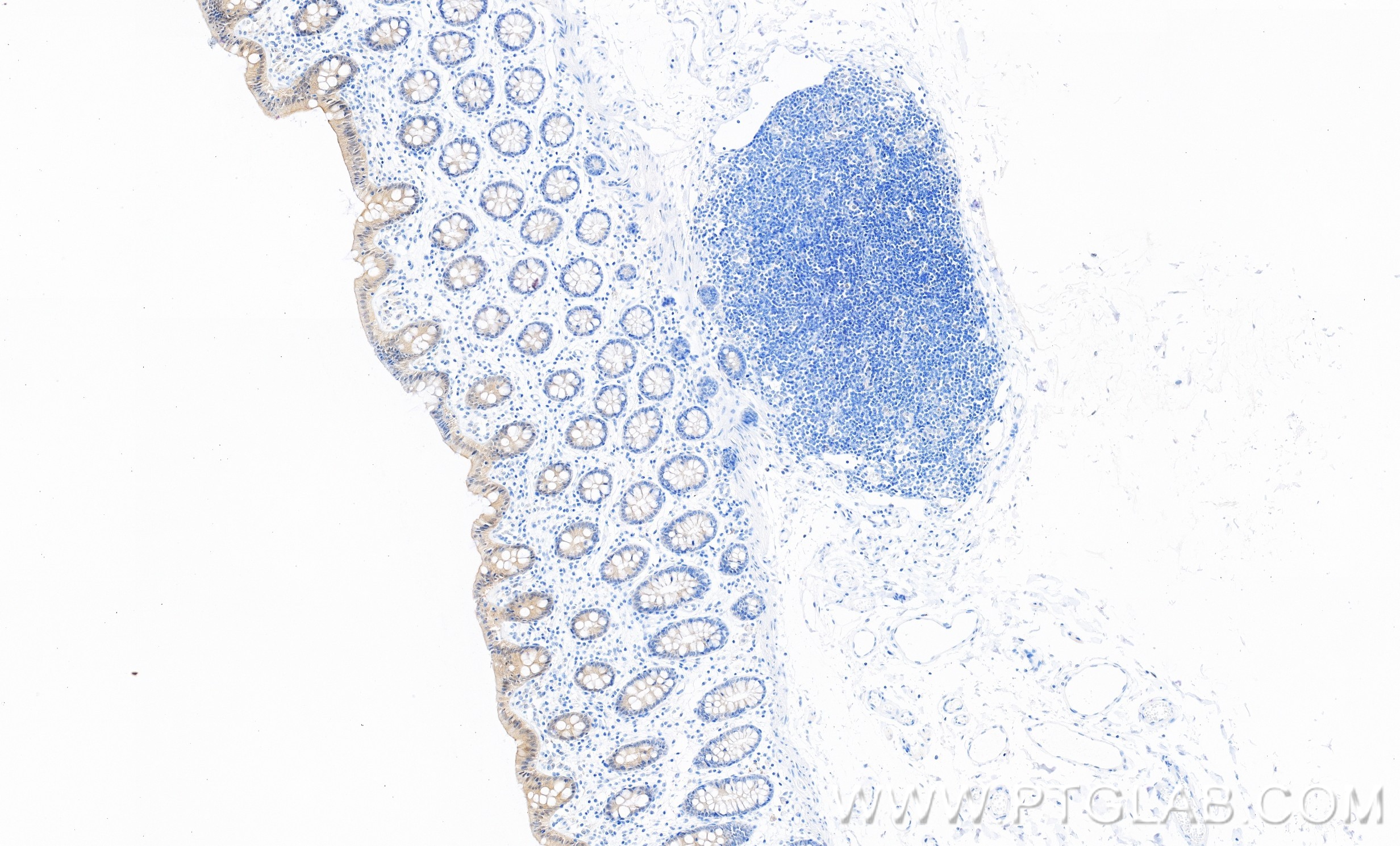 IHC staining of human colon using 86423-2-RR (same clone as 86423-2-PBS)