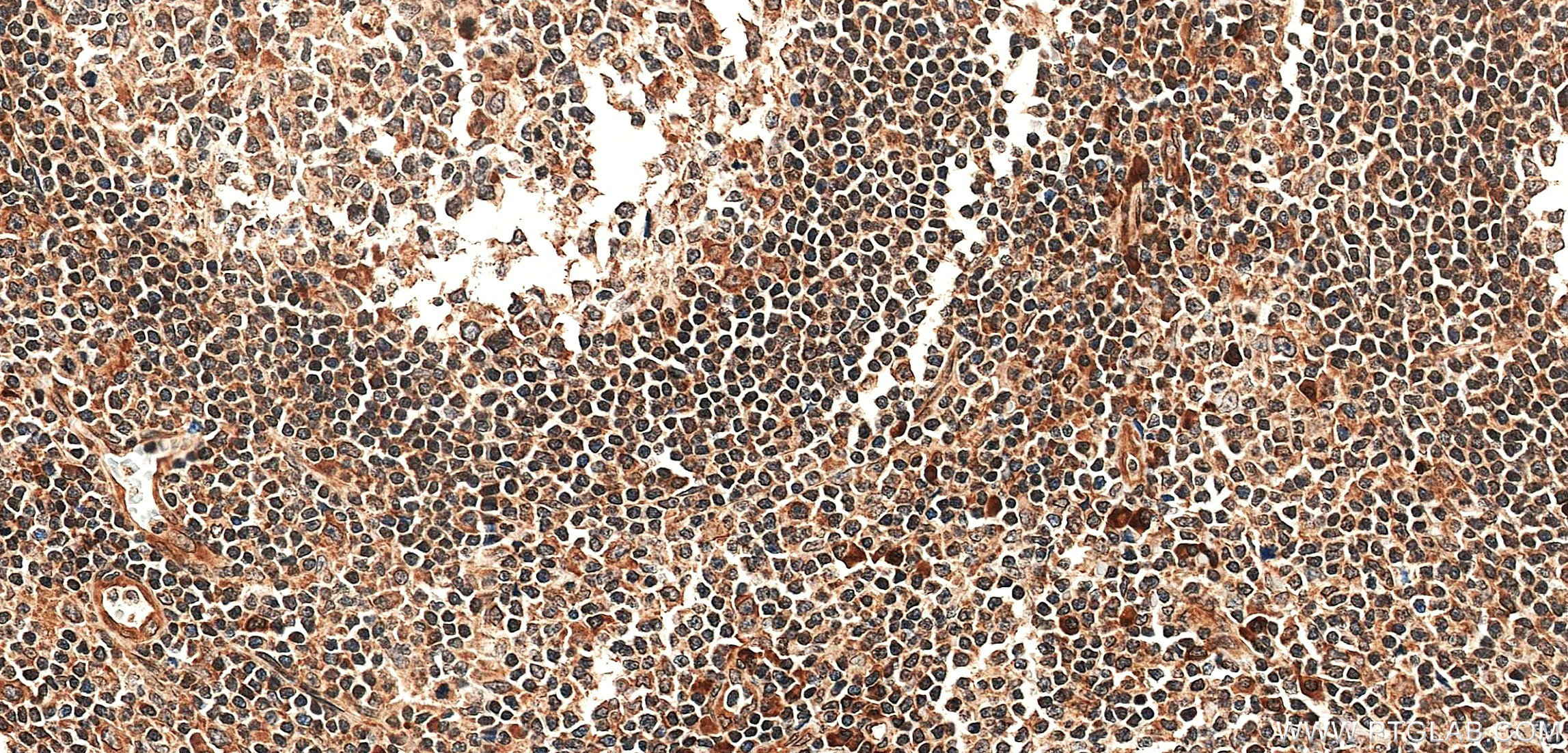 IHC staining of human tonsil using 85196-3-RR IHC staining of human tonsil using 85196-3-RR