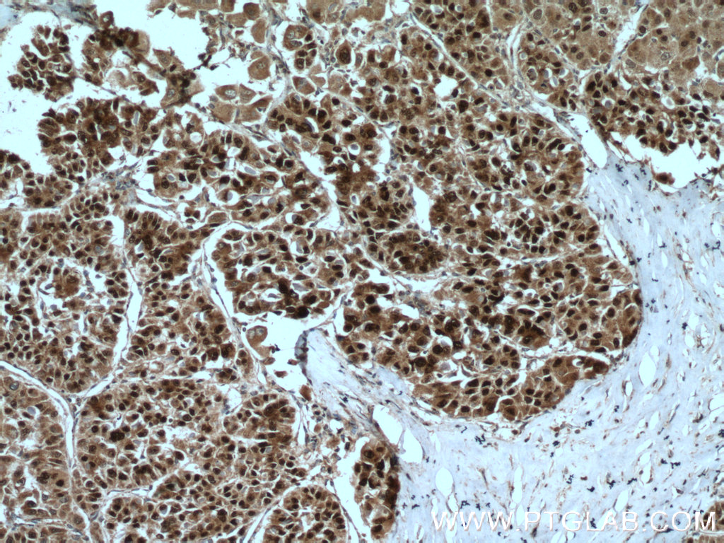 IHC staining of human liver cancer using 24777-1-AP