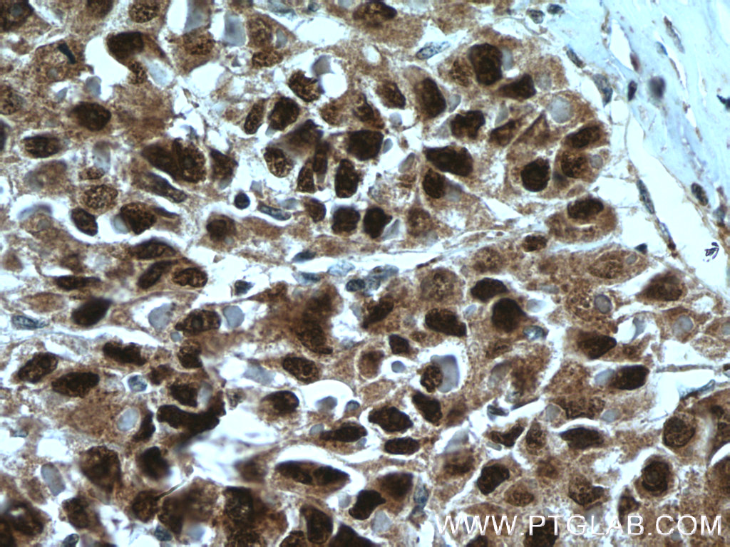 IHC staining of human liver cancer using 24777-1-AP