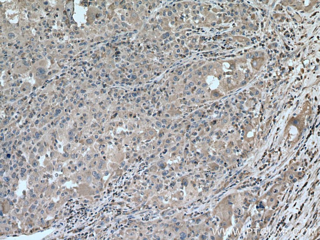 IHC staining of human liver cancer using 67398-1-Ig