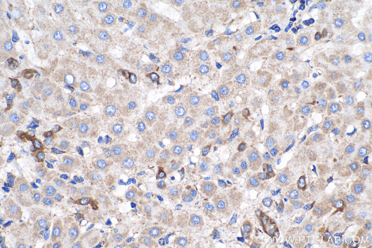 IHC staining of human liver cancer using 67956-1-Ig