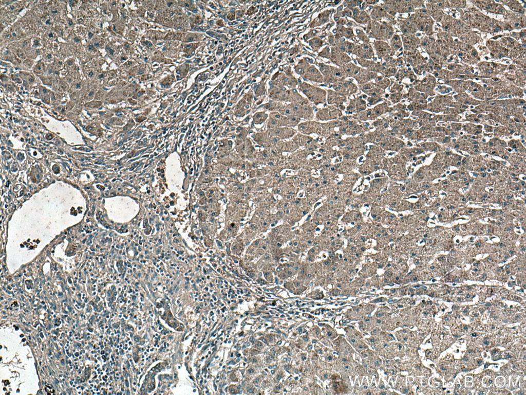 IHC staining of human hepatocirrhosis using 66765-1-Ig