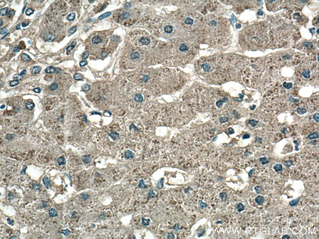 IHC staining of human hepatocirrhosis using 66765-1-Ig (same clone as 66765-1-PBS)