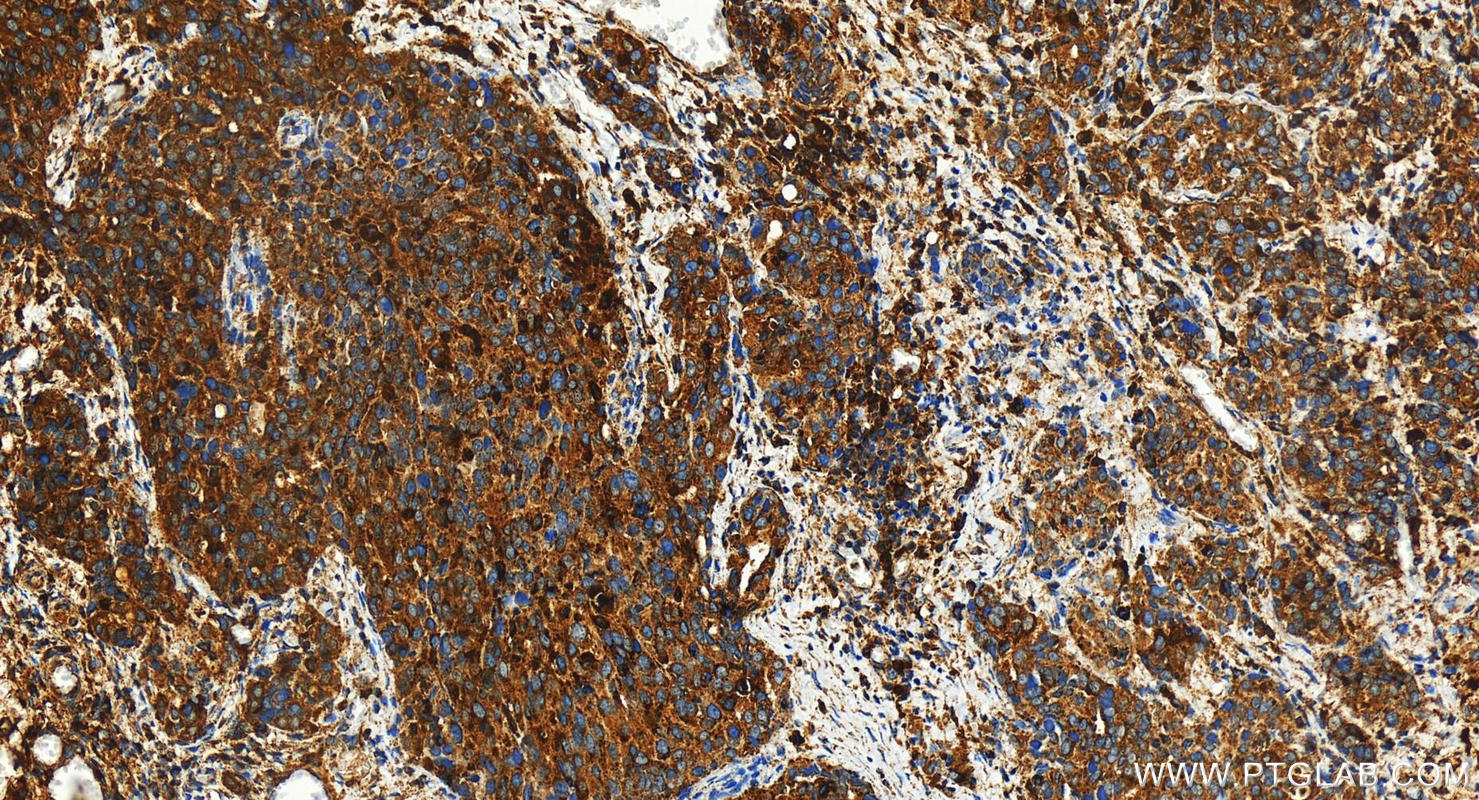 IHC staining of human ovary cancer using 31516-1-AP