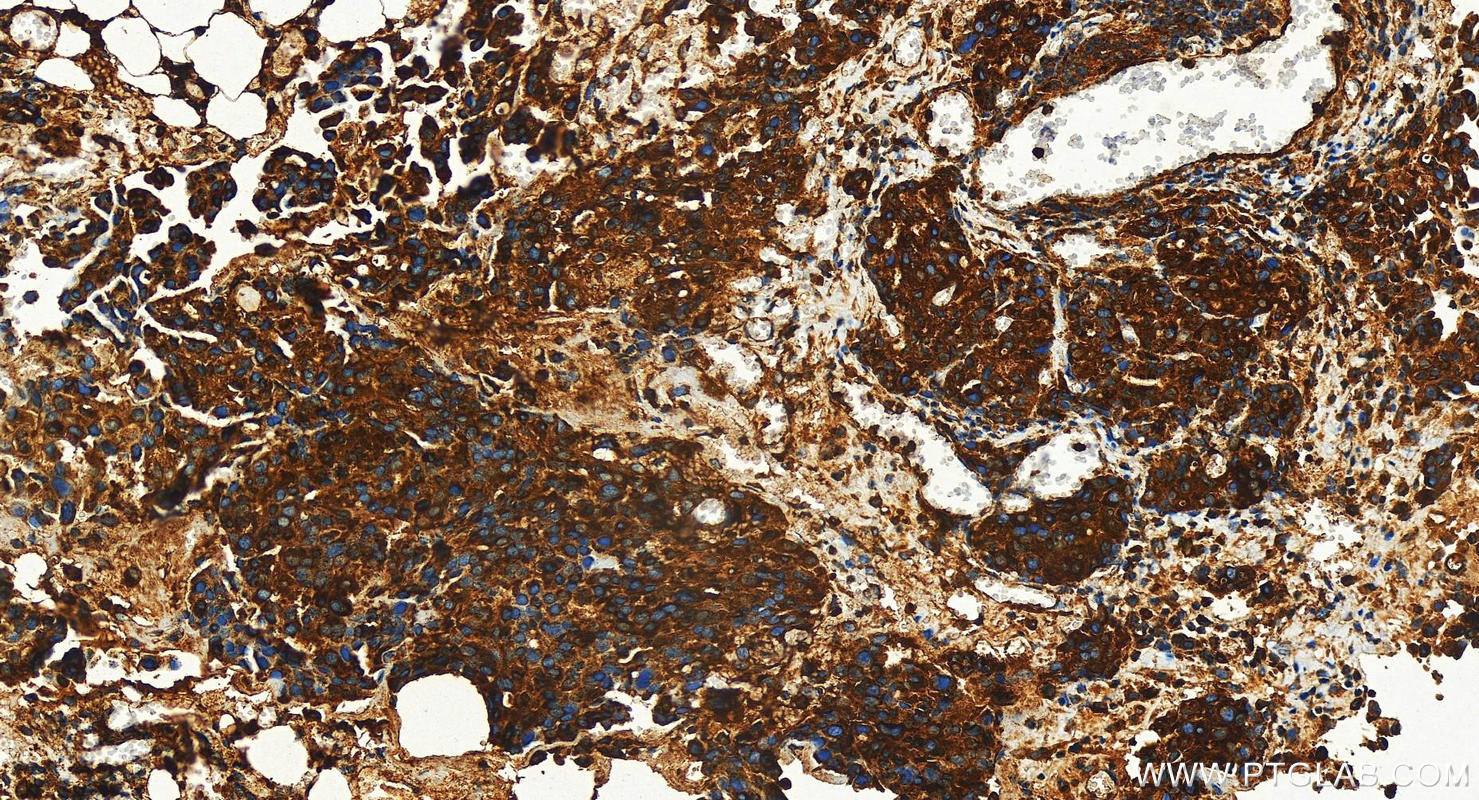 IHC staining of human ovary cancer using 31516-1-AP