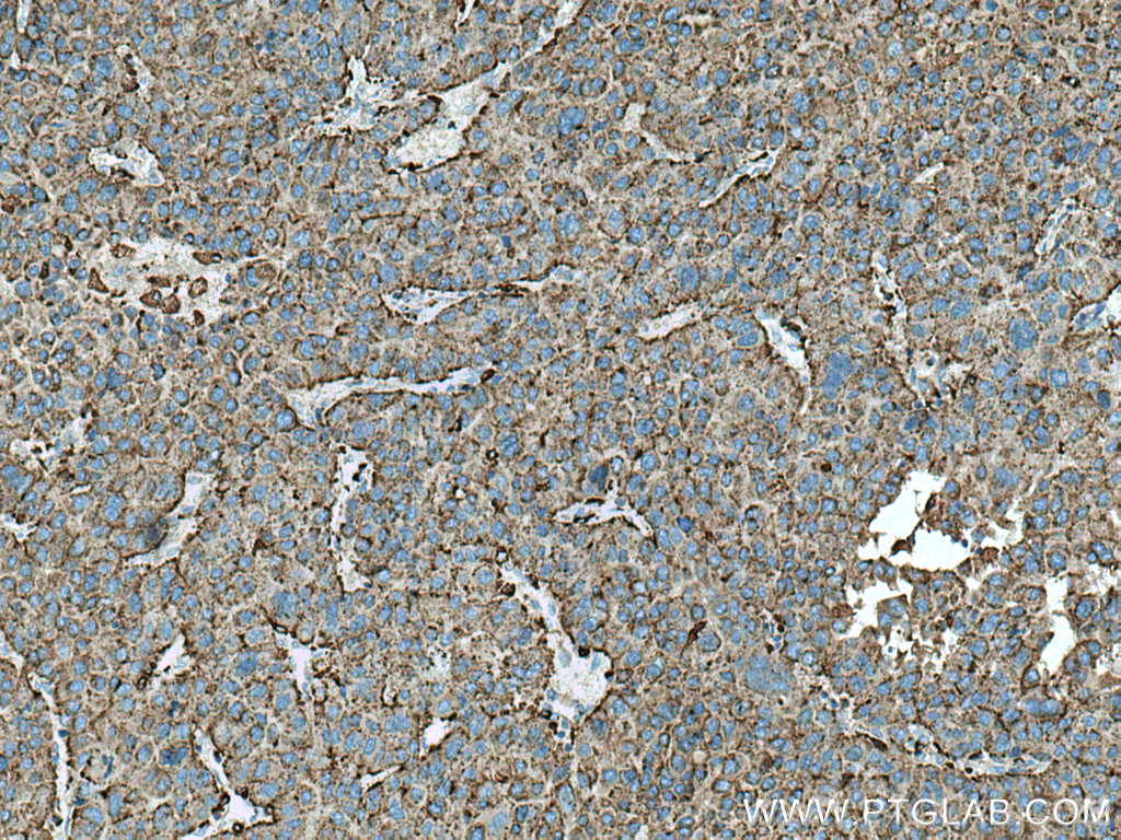 IHC staining of human liver cancer using 66534-1-Ig
