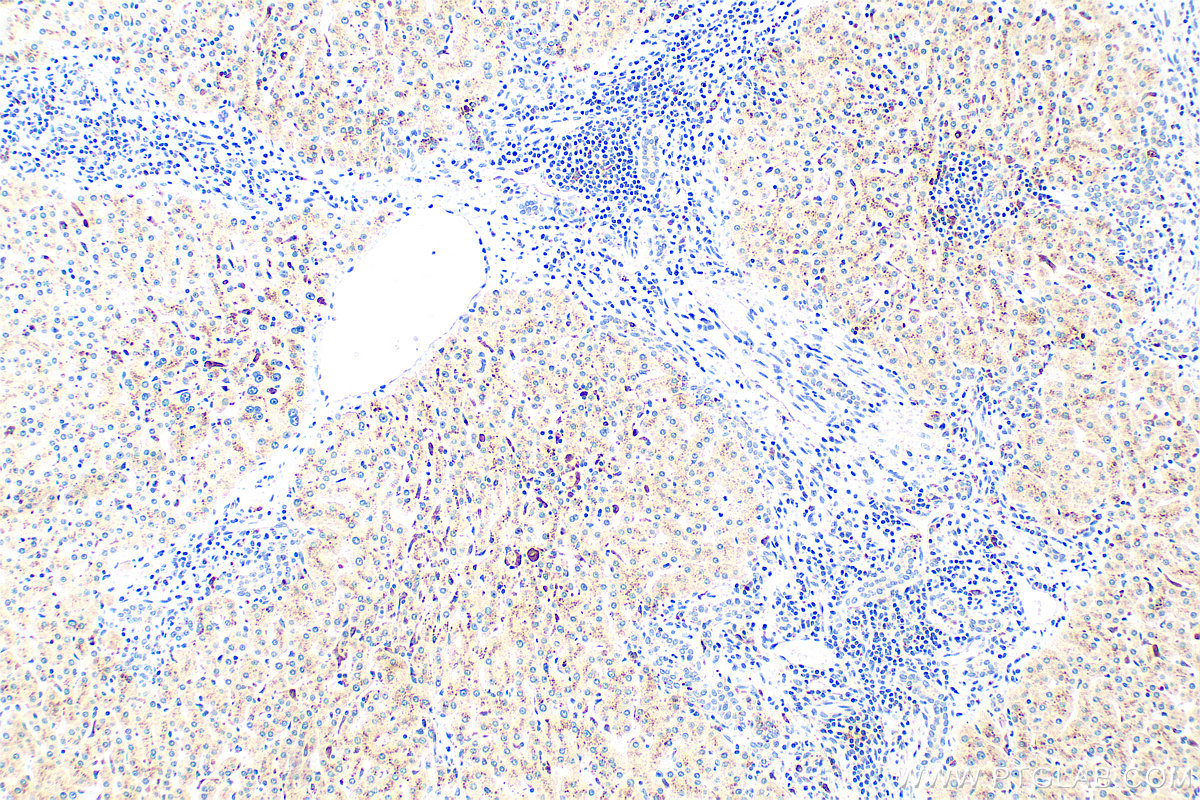IHC staining of human hepatocirrhosis using RMX00012 IHC staining of human hepatocirrhosis using RMX00012