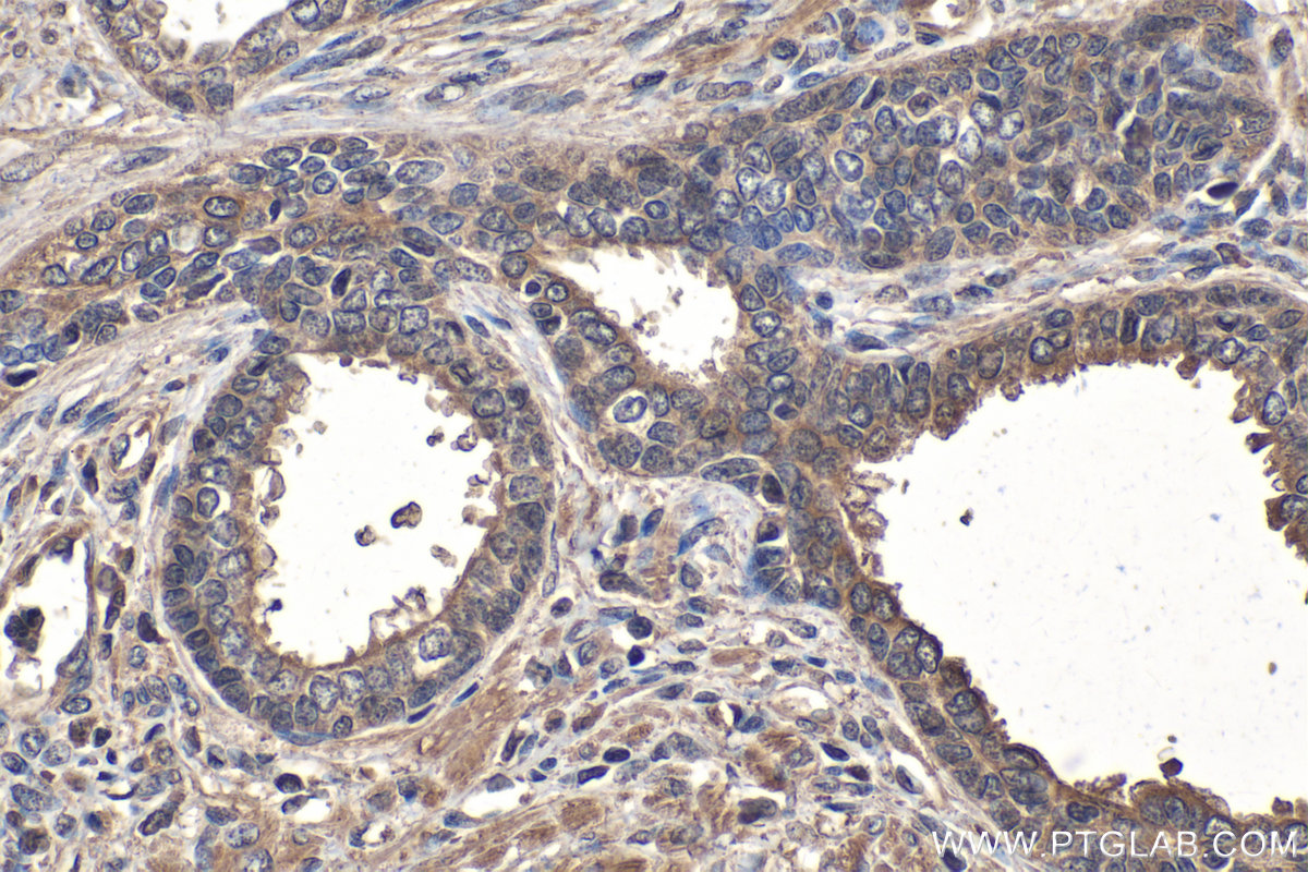 IHC staining of human prostate cancer using 66914-1-Ig (same clone as 66914-1-PBS)
