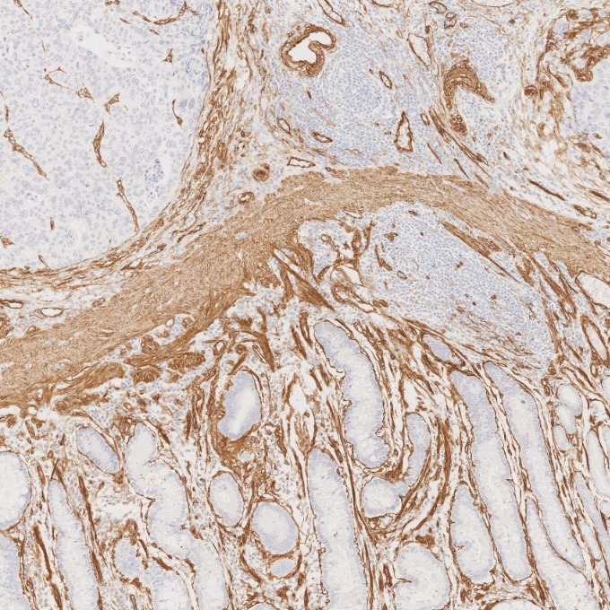 IHC staining of human stomach cancer using 84044-1-RR