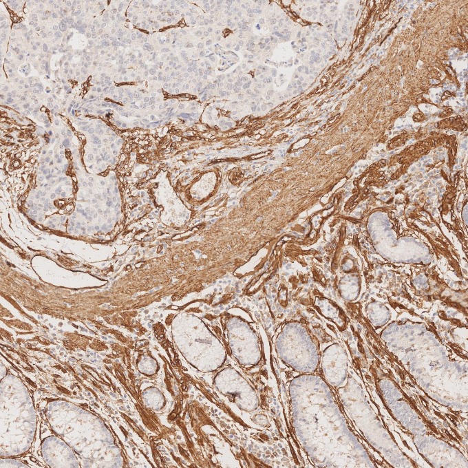 IHC staining of human stomach cancer using 84044-1-RR