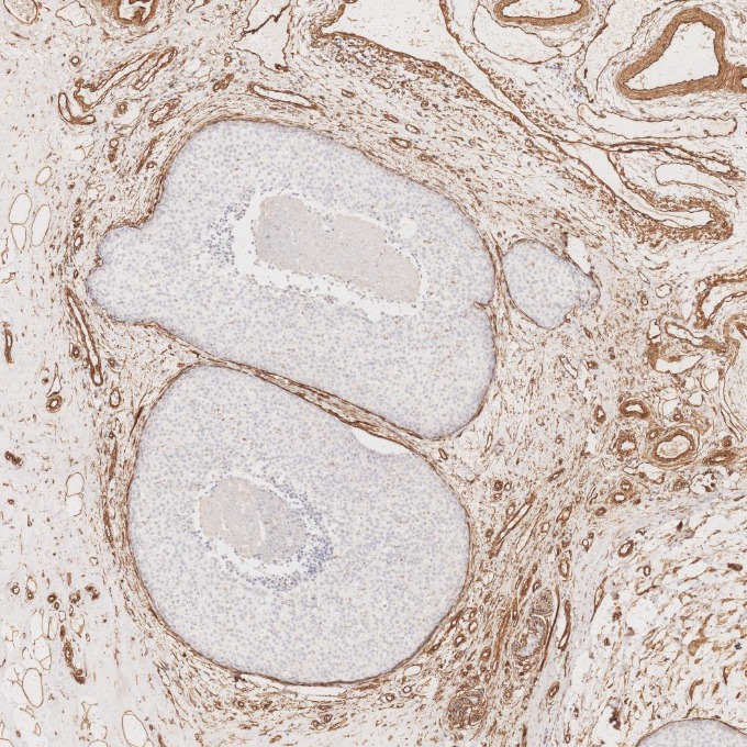 IHC staining of human breast cancer using 84044-1-RR