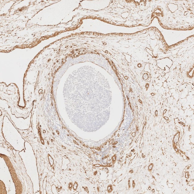IHC staining of human breast cancer using 84044-1-RR