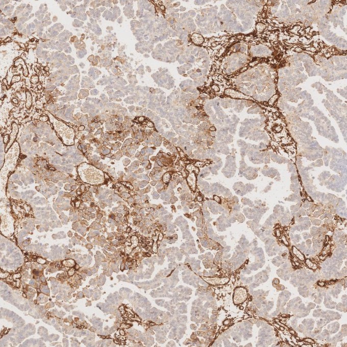 IHC staining of human ovary cancer using 84044-1-RR