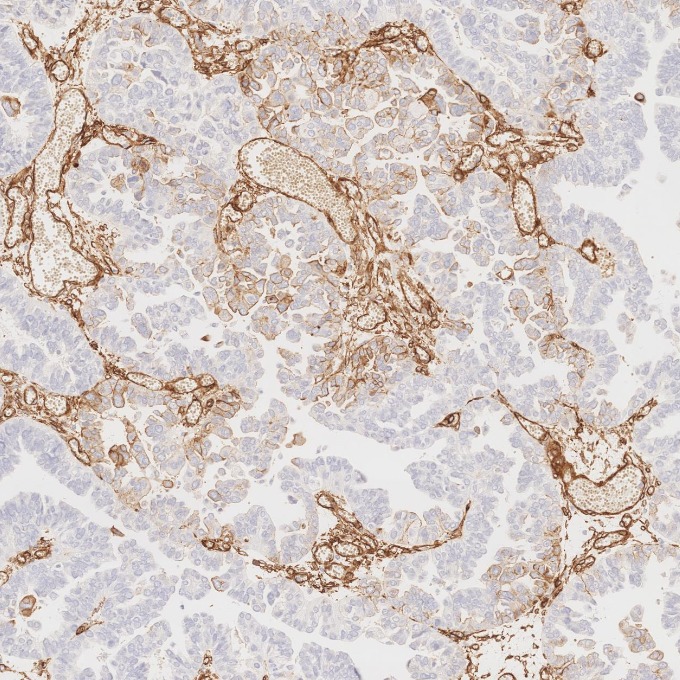 IHC staining of human ovary cancer using 84044-1-RR