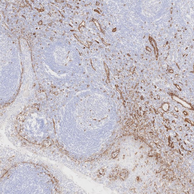 IHC staining of human tonsillitis using 84044-1-RR