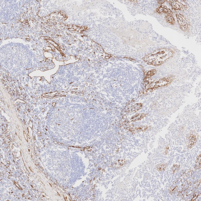 IHC staining of human tonsillitis using 84044-1-RR