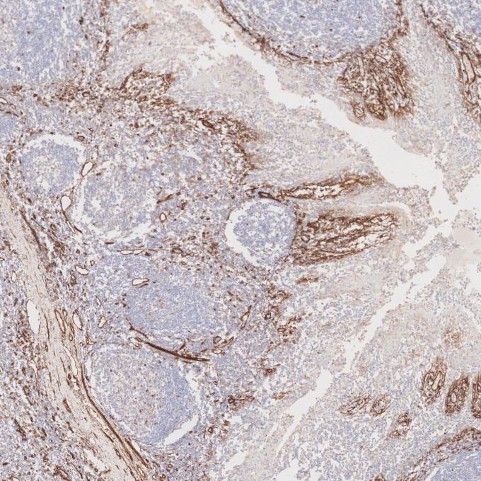 IHC staining of human tonsillitis using 84044-1-RR