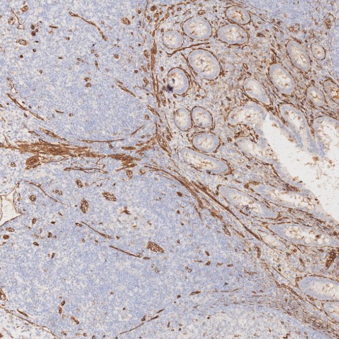IHC staining of human appendicitis using 84044-1-RR