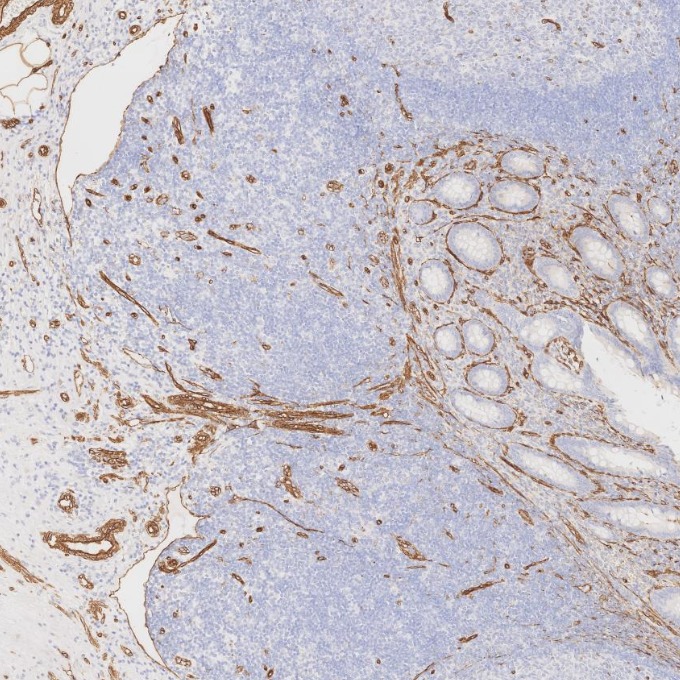 IHC staining of human appendicitis using 84044-1-RR