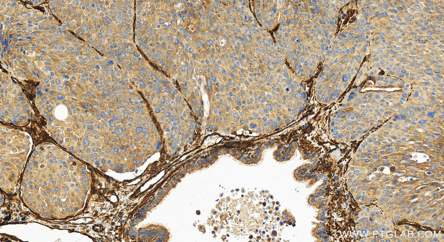 IHC staining of human lung squamous cell carcinoma using 84044-1-RR