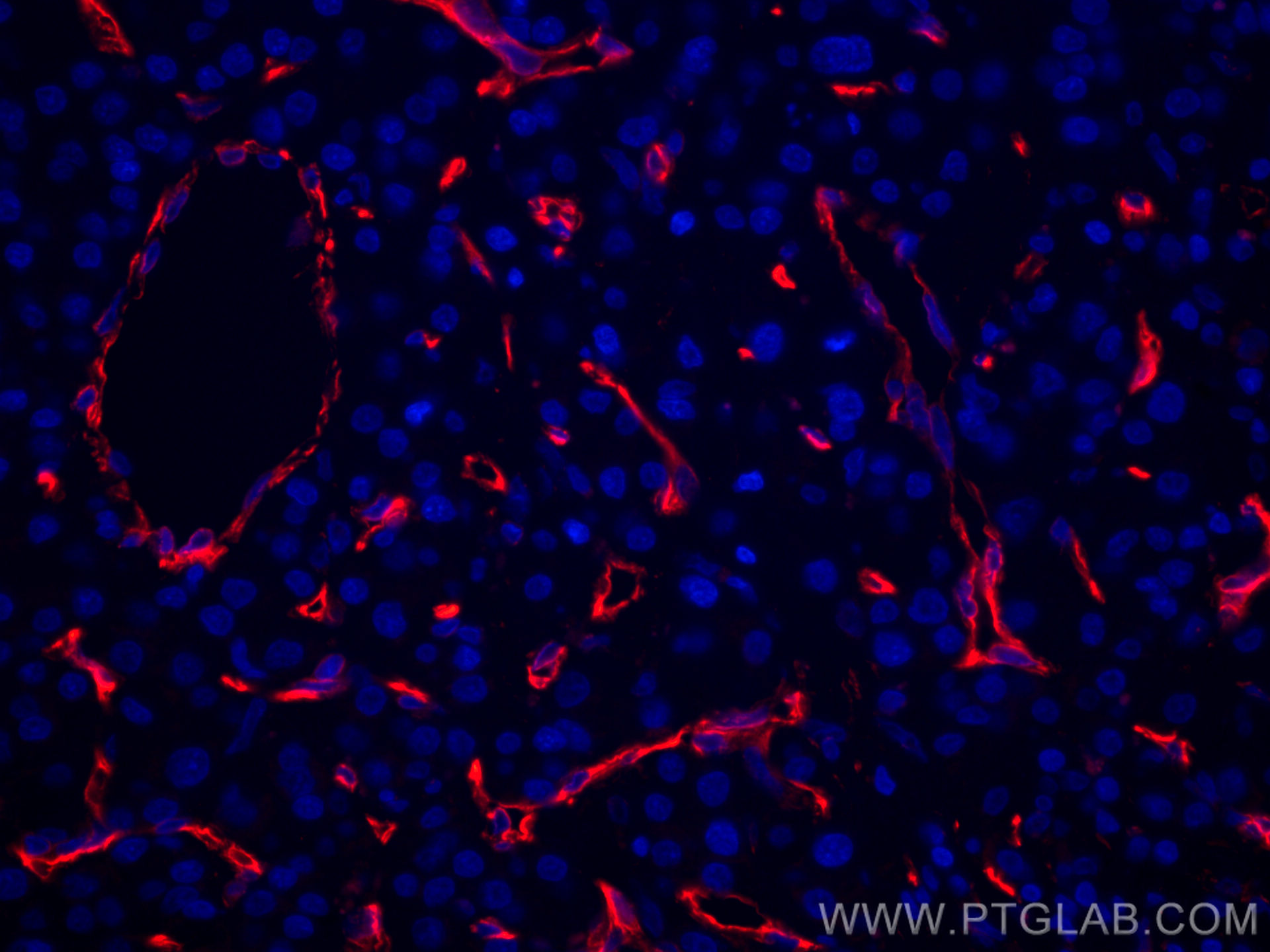 IF Staining of human liver cancer using CL594-66067