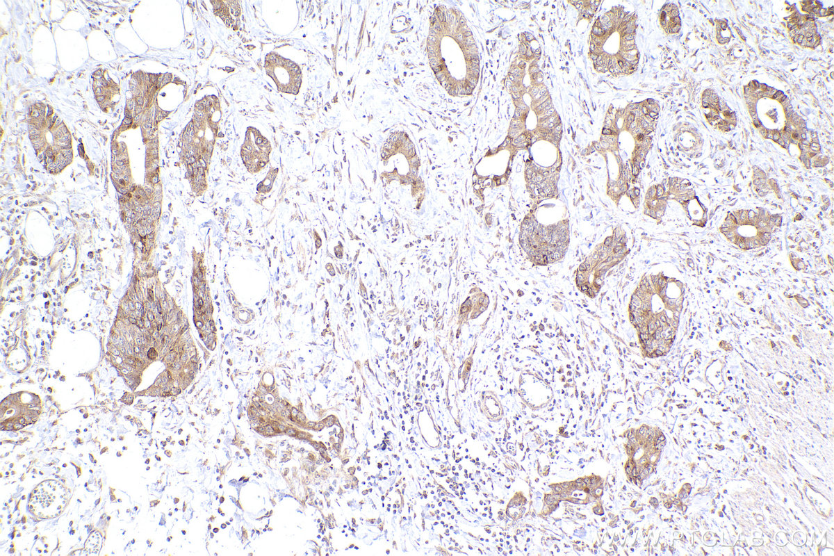 IHC staining of human rectal cancer using 26457-1-AP IHC staining of human rectal cancer using 26457-1-AP