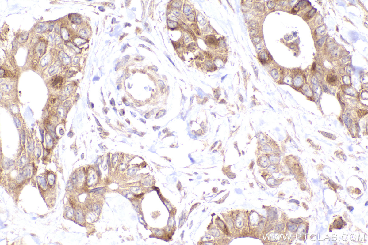 IHC staining of human rectal cancer using 26457-1-AP IHC staining of human rectal cancer using 26457-1-AP