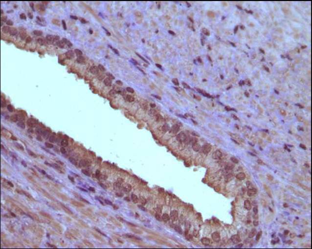 IHC staining of human prostate cancer using 65016-1-Ig